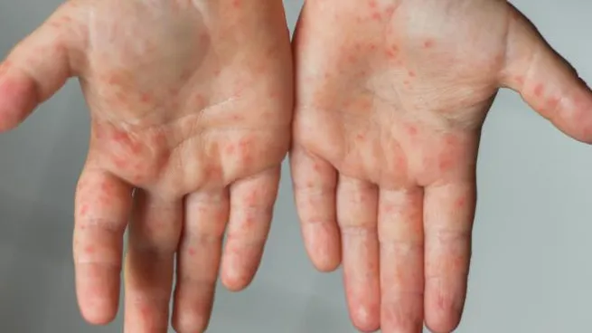 viruela-del-monojpeg