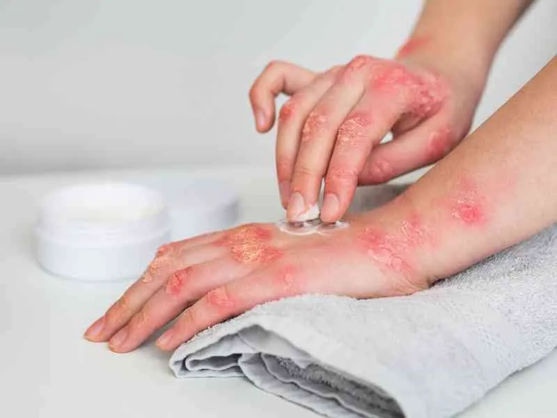 hands-of-patient-suffering-from-psoriasis