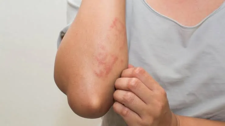 dermatitis