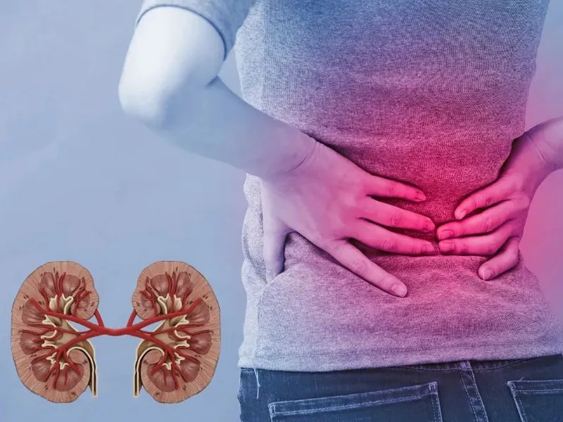 piedras-en-los-riñones