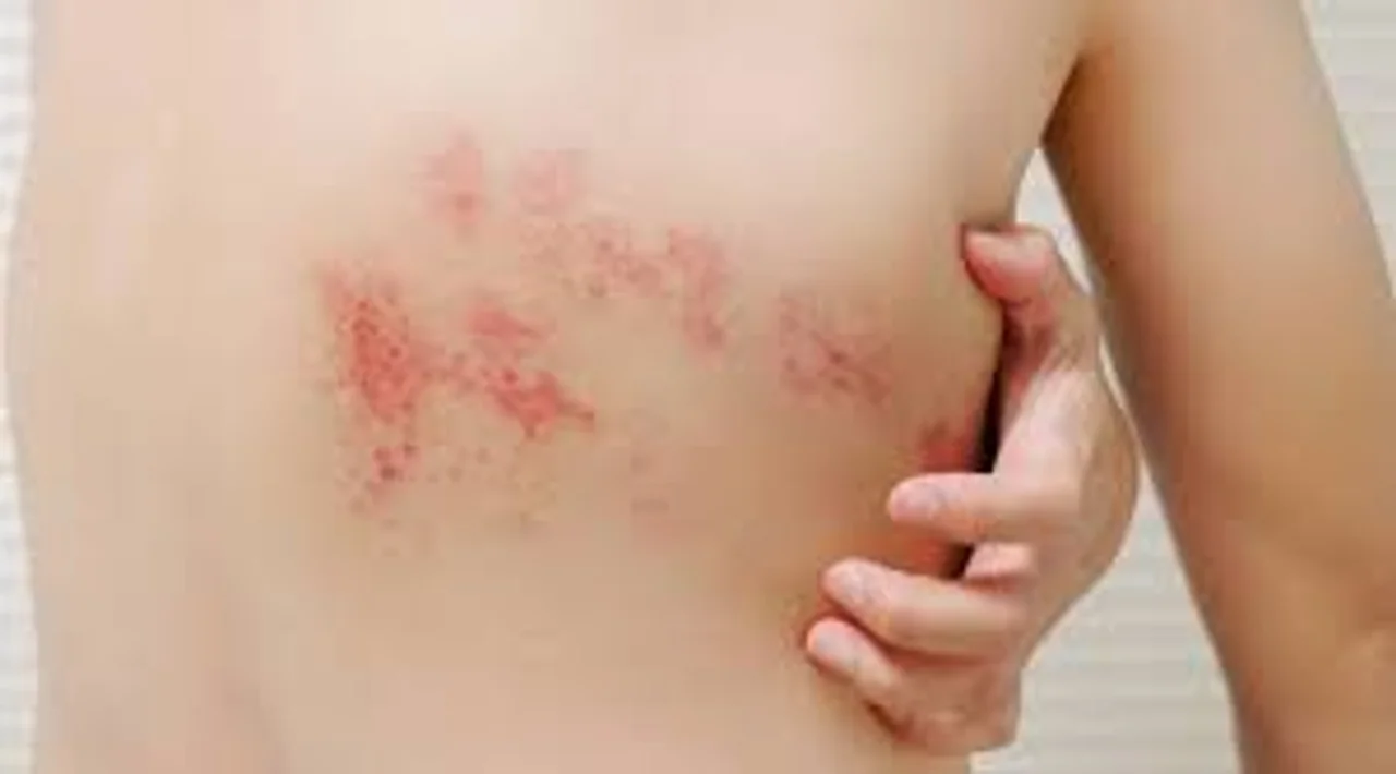 herpes